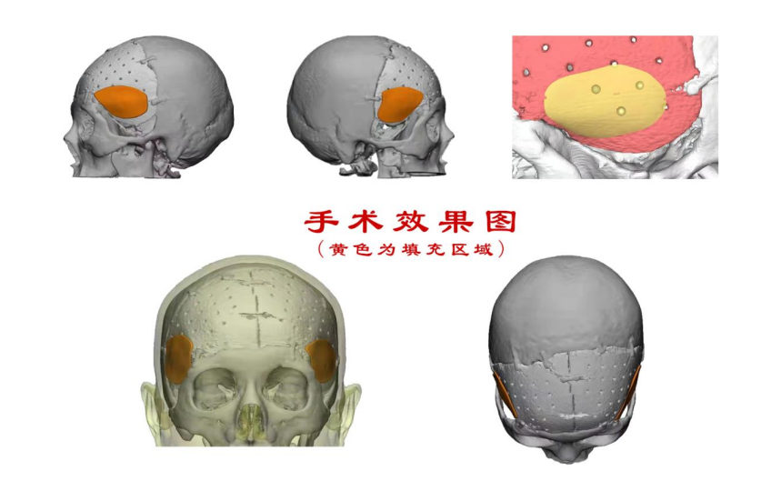林志穎車禍致顏面骨折，醫(yī)生：或可用3D打印建模進行術后修復