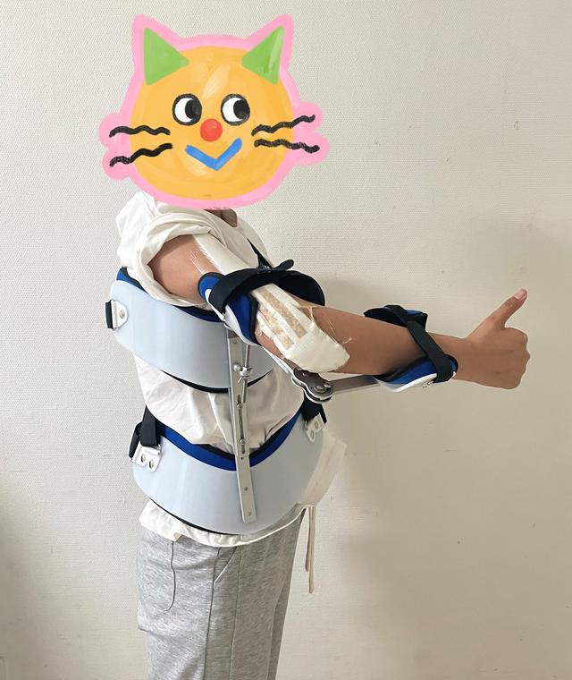 13歲少女患骨肉瘤面臨截肢，3D打印肱骨假體治療成功保肢